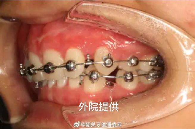 拔门牙矫正容易牙齿松动吗_牙齿矫正拔下门牙_牙齿矫正拔牙会松动吗