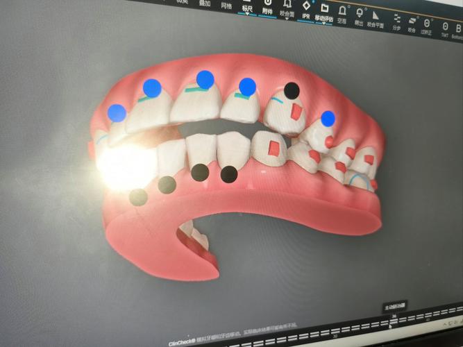 拔门牙矫正容易牙齿松动吗_牙齿矫正拔下门牙_牙齿矫正拔牙会松动吗