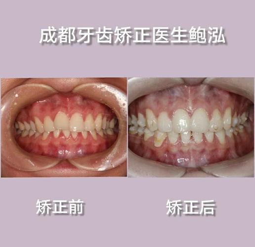 深圳深覆合牙齿矫正多少钱_牙齿覆合矫正多少钱_深覆合整牙价格
