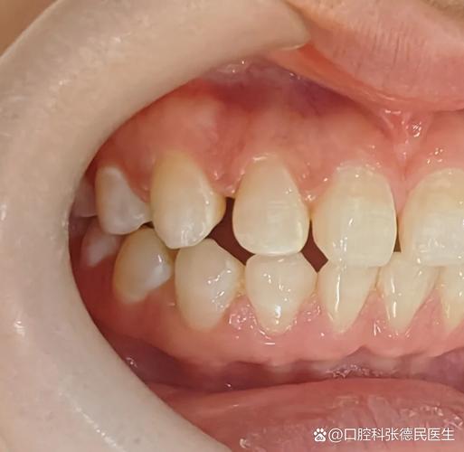 深圳牙缝过大矫正多少钱？最新价格一览
