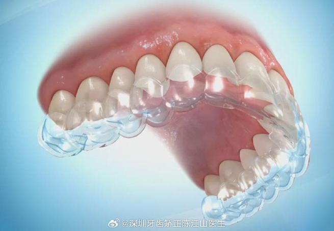 牙齿矫正能_23岁了还可以去矫正牙齿吗_牙齿矫正去可以刷牙吗
