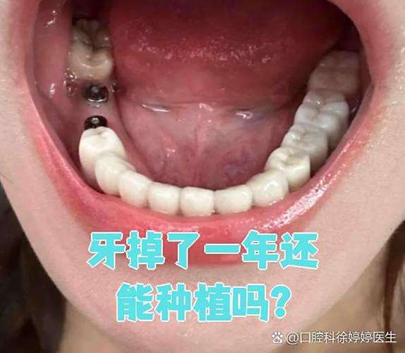 种牙坏了能二次种植吗_种植牙损坏后能再种植吗_牙齿破裂可以种植吗