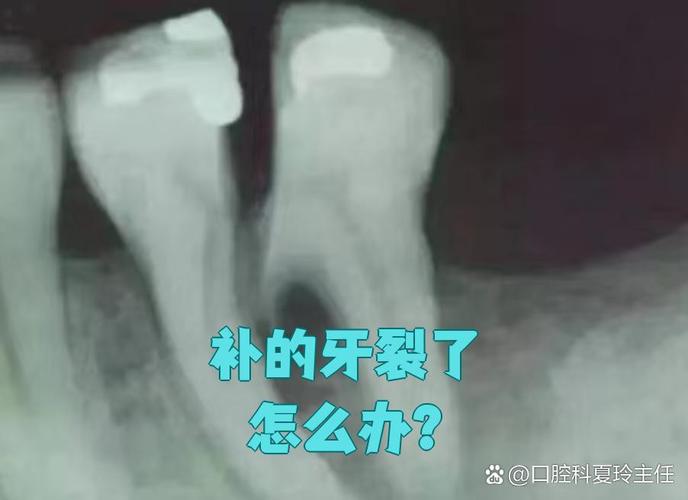 种牙坏了能二次种植吗_种植牙损坏后能再种植吗_牙齿破裂可以种植吗