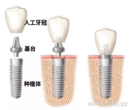 牙种植价格_深圳南山韩国登腾种植牙价格_登腾现代口腔种植强化培训
