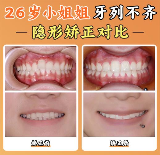 北京舌侧矫正_舌侧矫正价格_舌侧矫正钟浩医生