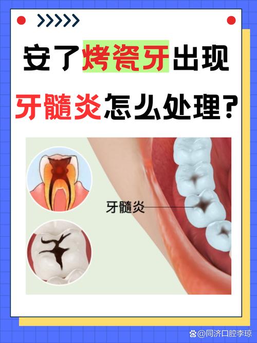 牙医良心忠告:做烤瓷牙前这两点不注意,当心毁了整口牙