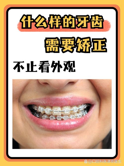 牙齿矫正最佳年龄段_牙齿矫正大概需要多少钱_45岁矫正牙齿