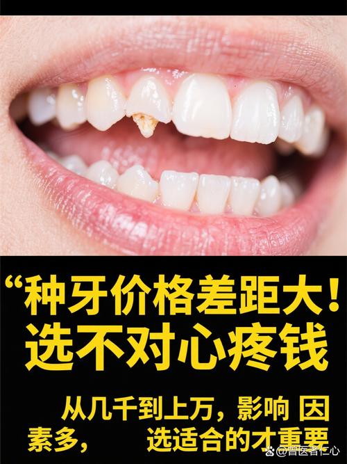 种植牙再等5年爆发？价格已降，技术更微创，缺牙患者有福了