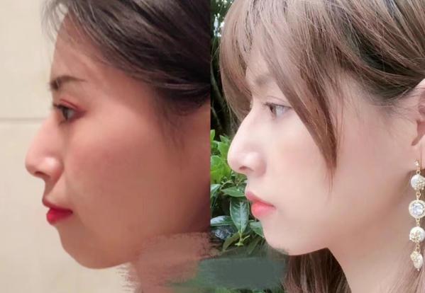 深圳隐适美隐形矫正价格明细_深圳隐适美价格_深圳隐适美矫正大概多少钱