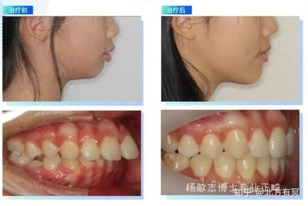 mrs肌功能矫正器_深圳MRC肌功能矫正多少钱_肌功能正畸