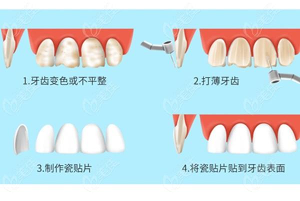 深圳牙齿贴面收费_医院牙齿贴面_在牙科牙齿贴面需要多少钱