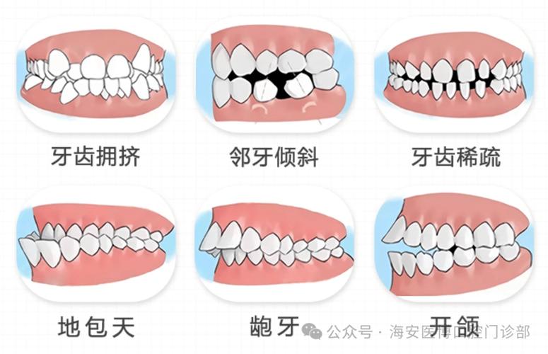 正畸成人牙齿矫正要多久_成人暴牙正畸要多少钱_成人正畸的危害