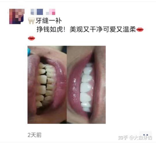7岁小孩牙齿矫正大概要花费多少钱_牙齿矫正花费小孩钱要赔偿吗_孩子牙齿矫正算不算医疗费用