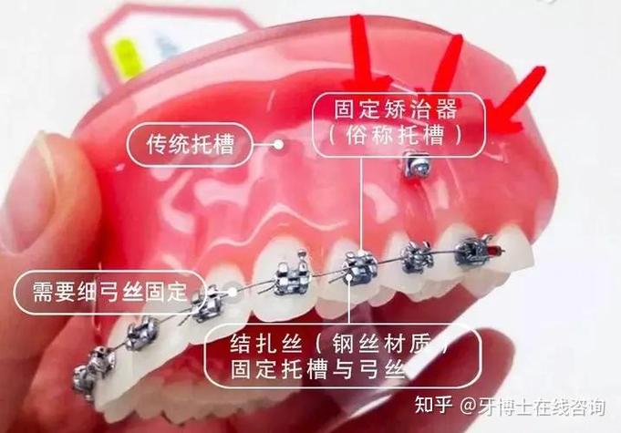 隐适美牙齿矫正价格_隐形矫正费用明细_深圳隐适美隐形矫正价格明细