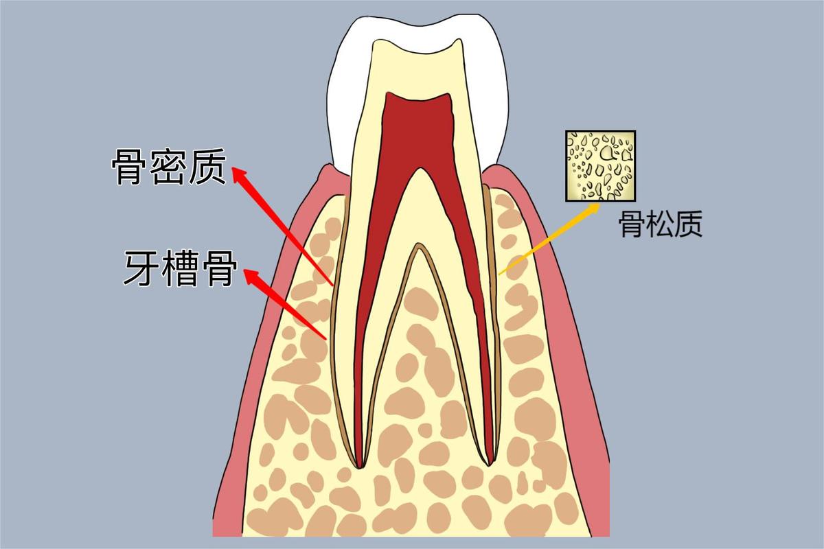 牙槽骨吸收可以种牙吗_牙槽骨吸收种牙_牙槽骨吸收后能做根管吗