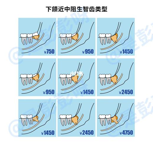 杭州口腔拔牙最厉害三个医院_杭州口腔医院拔智齿价格_杭州口腔医院拔牙