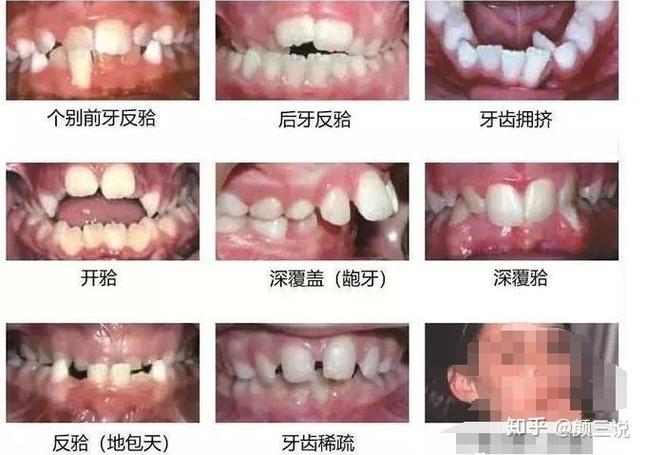青岛儿童正畸科最好的医院_青岛儿童正畸_青岛儿童正畸哪个医生好