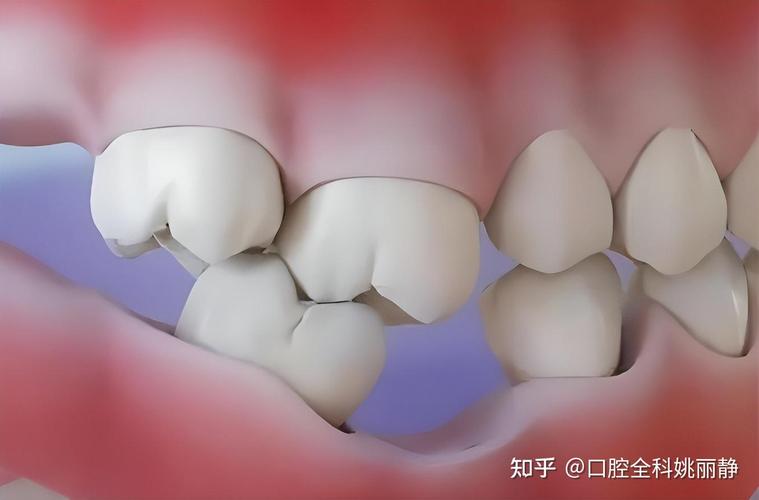 儿童牙齿缺损_儿童缺牙_儿童缺牙怎么处理