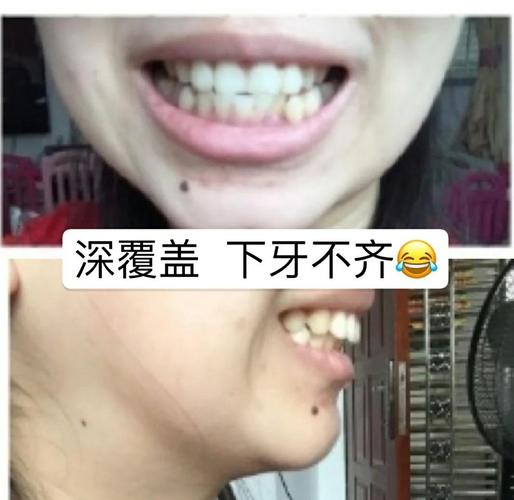 成人矫正牙齿有效果吗_成人矫正牙齿的利与弊知乎_成人矫正龅牙哪里较好