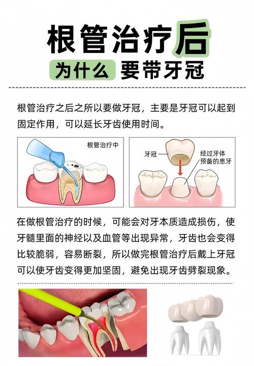 根管治疗补牙到底怎么回事？医生详解步骤和必要性