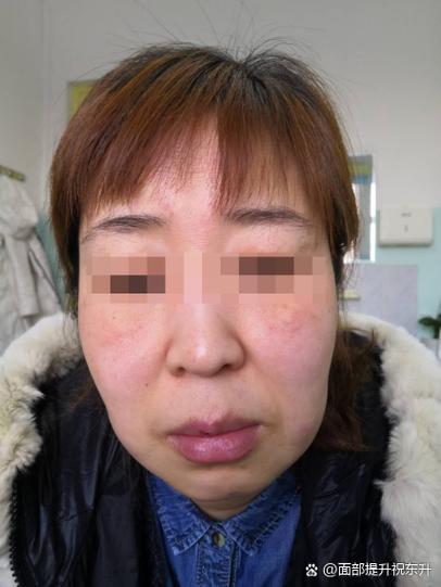 补牙后脸疼怎么办_补牙后半个脸疼_补牙后半边脸断断续续的疼