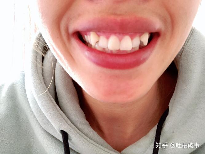 牙齿矫正虎牙多久能拉下来_牙齿矫正虎牙快速矫正方法_虎牙快速牙齿矫正