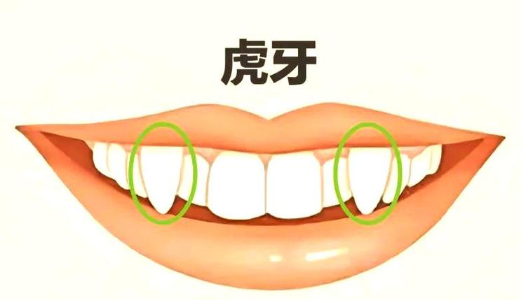 牙齿矫正虎牙快速矫正方法_虎牙快速牙齿矫正_牙齿矫正虎牙多久能拉下来