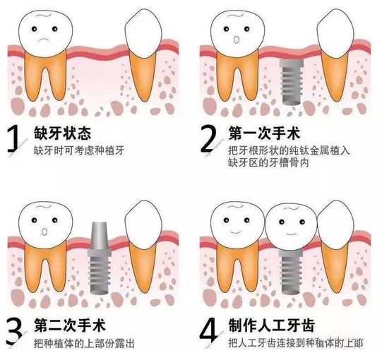 多颗牙缺失种牙多少钱_牙齿缺失种牙好还是矫正好_牙齿缺失种牙多少钱