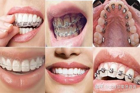 在深圳矫正牙齿可以用医保吗_深圳30岁还能做牙齿矫正吗_牙齿矫正还能深圳做吗