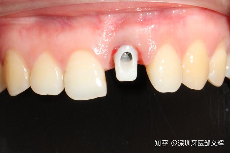 大牙坏了还能马上种吗？牙医揭秘即拔即种的真相与风险
