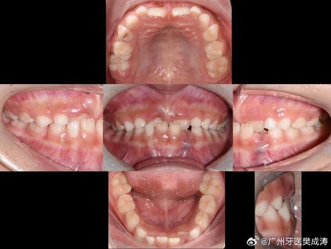 深圳换牙期牙齿错位干预_深圳换牙期牙齿错位干预_深圳换牙期牙齿错位干预