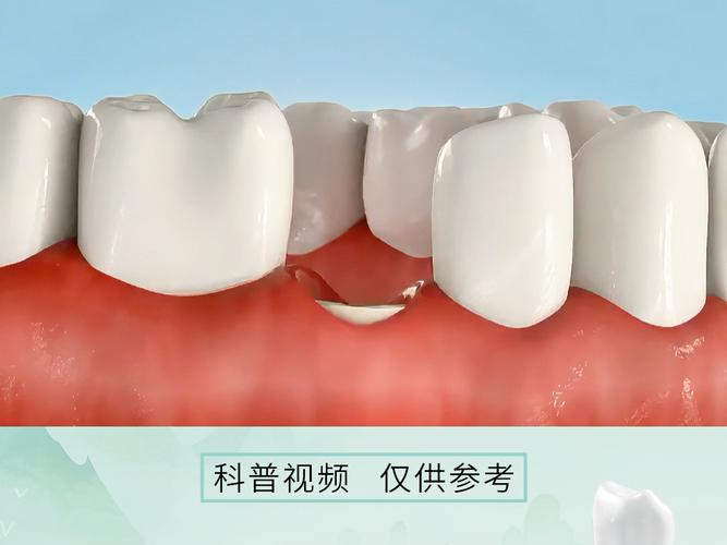 根管冶疗做牙冠多少钱_牙根管治疗加牙冠多少钱_福田区根管治疗后需要做牙冠吗