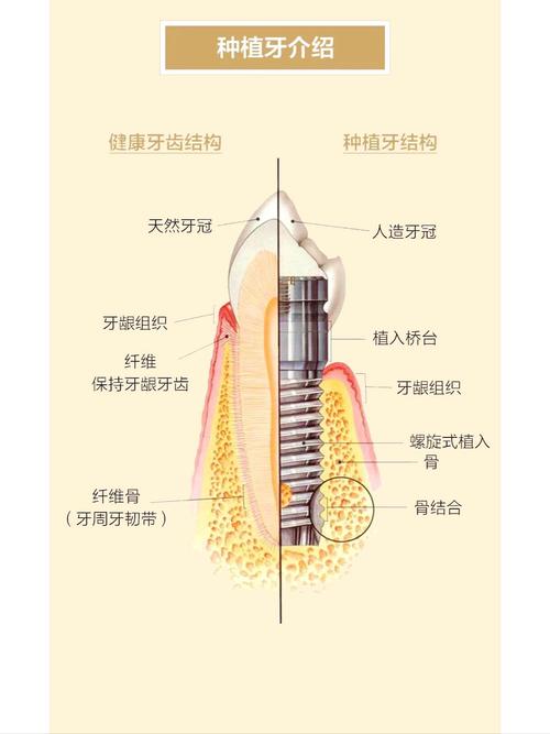 什么叫种植牙齿 一篇讲清原理过程
