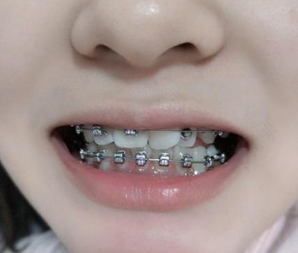 牙齿矫正痛吗孩子能忍受吗_牙齿矫正痛不痛_把牙齿矫正痛吗