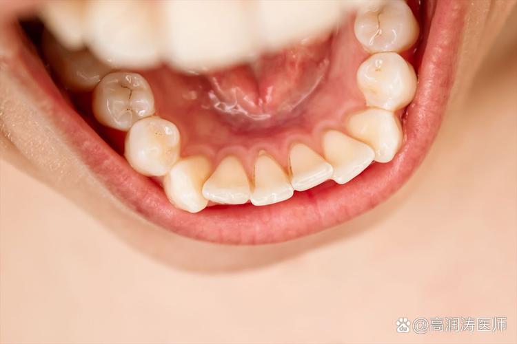深圳换牙期牙齿错位干预_深圳换牙期牙齿错位干预_深圳换牙期牙齿错位干预