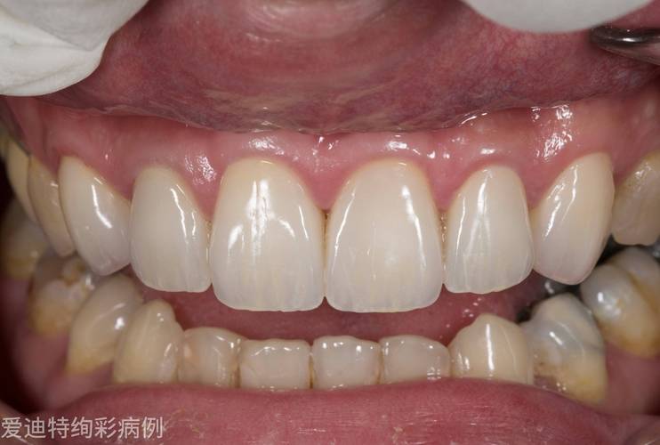 深圳烤瓷牙哪家做的好_深圳全瓷牙哪家牙科靠谱_深圳全瓷牙厂家