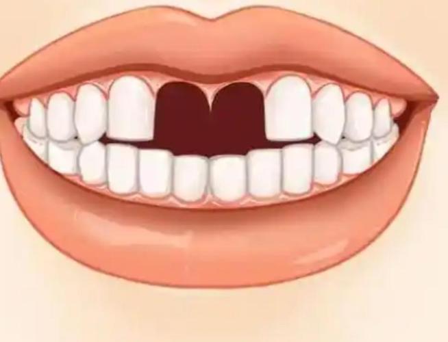补牙深圳哪家医院好_在深圳补牙_深圳补牙门诊哪家好