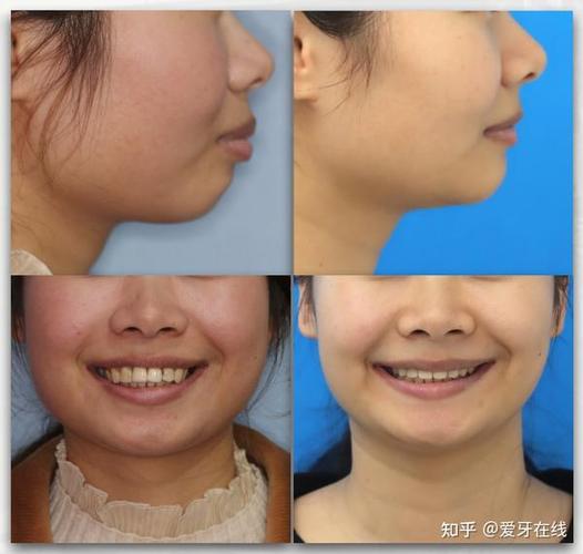牙齿矫正可以刷医保卡吗_牙齿矫正可以改变脸型吗_20岁可以矫正牙齿