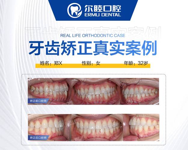 深圳南山MRC矫正医院推荐_深圳哪里有比较权威的矫正牙齿_南山市人民医院矫正牙齿多少钱