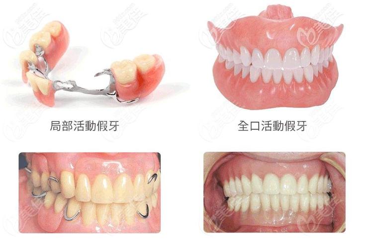 洛阳种植牙费用 2500-4700 元 2026_洛阳种植牙费用 2500-4700 元 2026_洛阳种植牙费用 2500-4700 元 2026