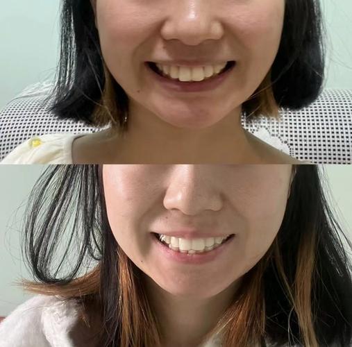 矫正龅牙费用_30多岁龅牙矫正_矫正龅牙的全过程