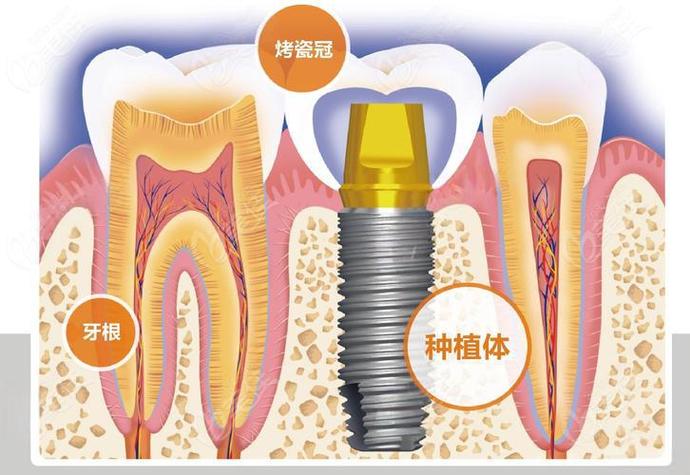 赤峰种牙费用详解：从预算到效果，给您的实惠指南