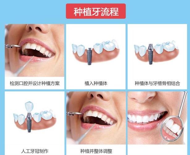 深圳宝安牙医_深圳宝安牙科诊所前十名_深圳宝安中老年半口种牙价格