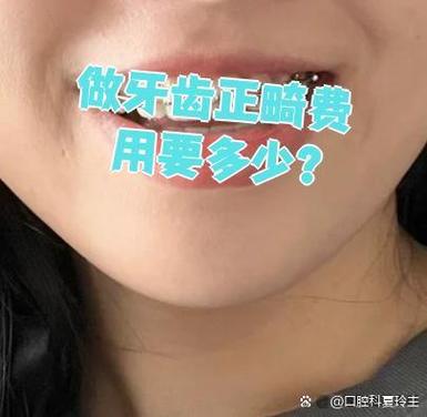 深圳福田青少年钢丝矫正牙齿要花多少钱