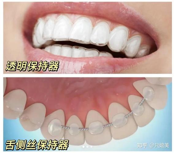 牙齿正畸费用多少_深圳福田青少年钢丝正畸费用_深圳福田罗湖人流费用