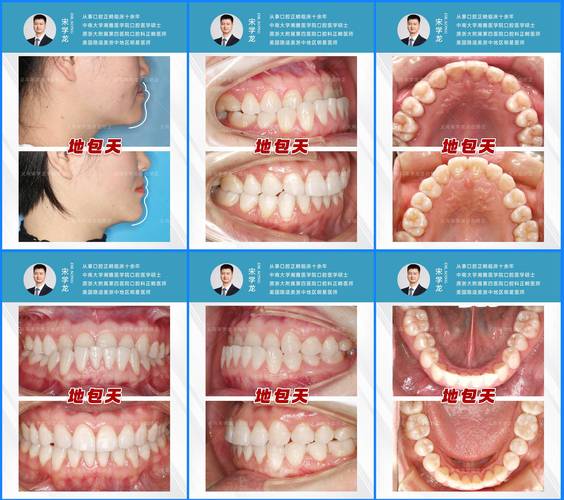 牙齿矫正多长需要时间完成_27岁矫正牙齿需要多长时间?_牙齿矫正大概多久