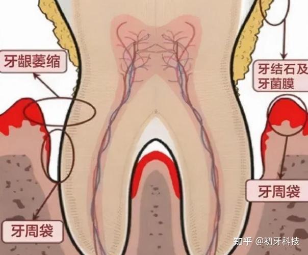 贵阳种植牙2026年单颗3500到5500元贵吗
