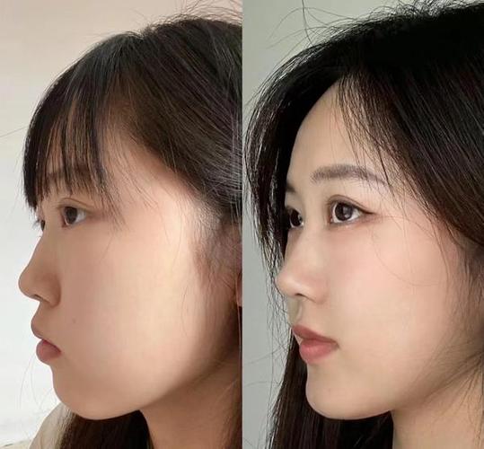 牙矫正需要多少钱_牙齿矫正龅牙_14岁龅牙矫正多少钱