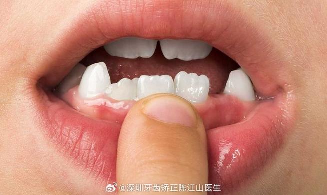 小孩的牙齿长成锯齿状是怎么回事_儿童牙锯齿状什么原因_儿童牙齿成锯齿状