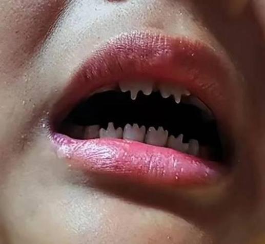 小孩的牙齿长成锯齿状是怎么回事_儿童牙齿成锯齿状_儿童牙锯齿状什么原因